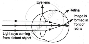 State reasons for Myopia. With the help of ray diagrams, show the ...